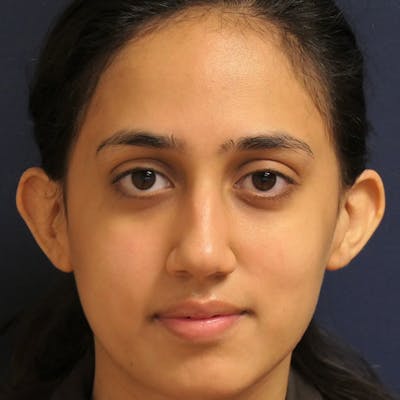 Ear Pinning (Otoplasty) Before & After Gallery - Patient 256429 - Image 1