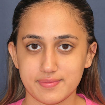 Ear Pinning (Otoplasty) Before & After Gallery - Patient 256429 - Image 2