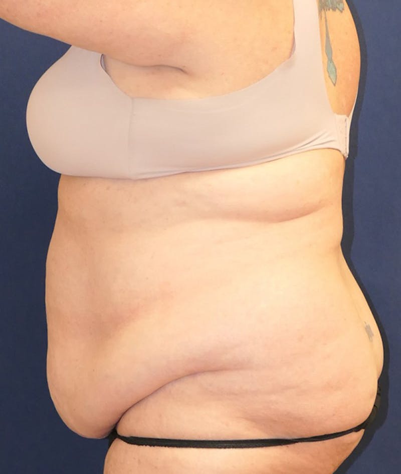 Tummy Tuck (Abdominoplasty) Before & After Gallery - Patient 241760 - Image 9