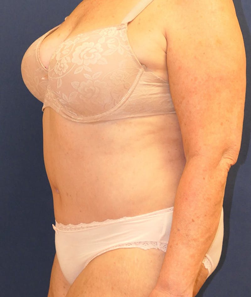 Tummy Tuck (Abdominoplasty) Before & After Gallery - Patient 241760 - Image 8