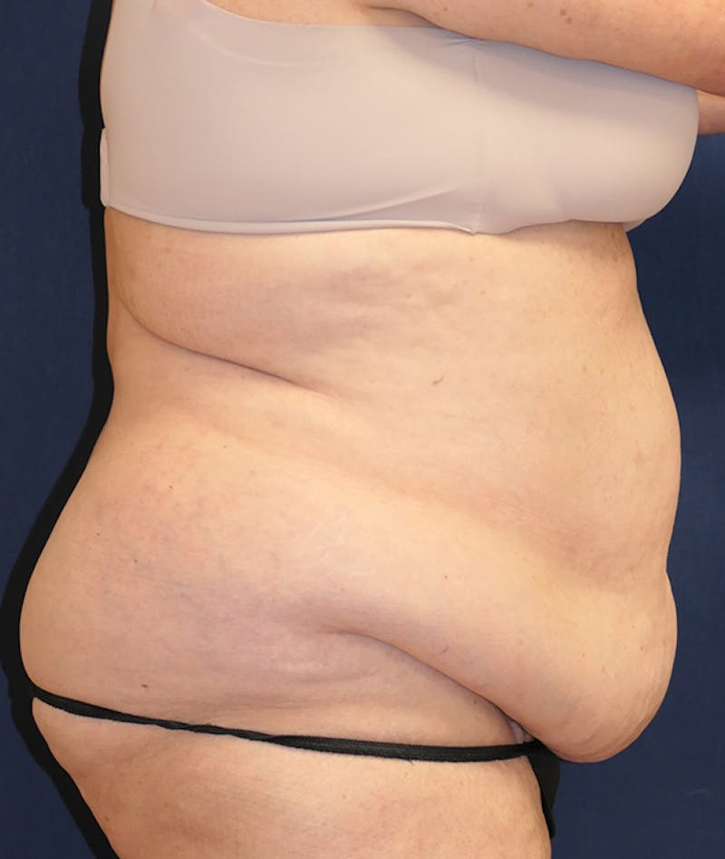 Tummy Tuck (Abdominoplasty) Before & After Gallery - Patient 241760 - Image 5