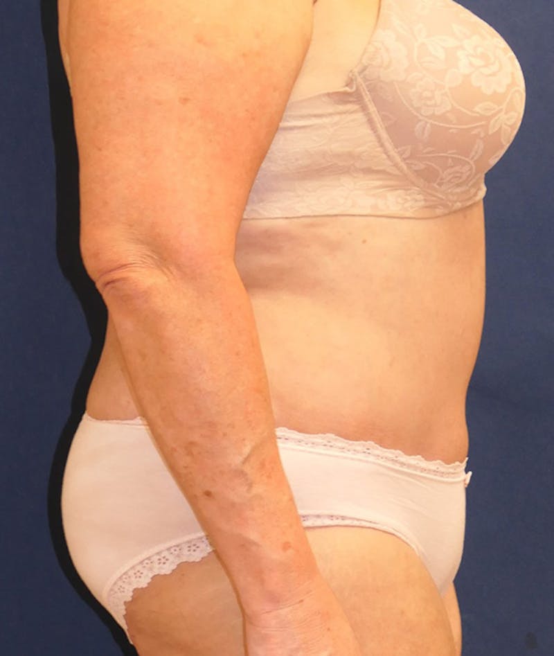 Tummy Tuck (Abdominoplasty) Before & After Gallery - Patient 241760 - Image 6