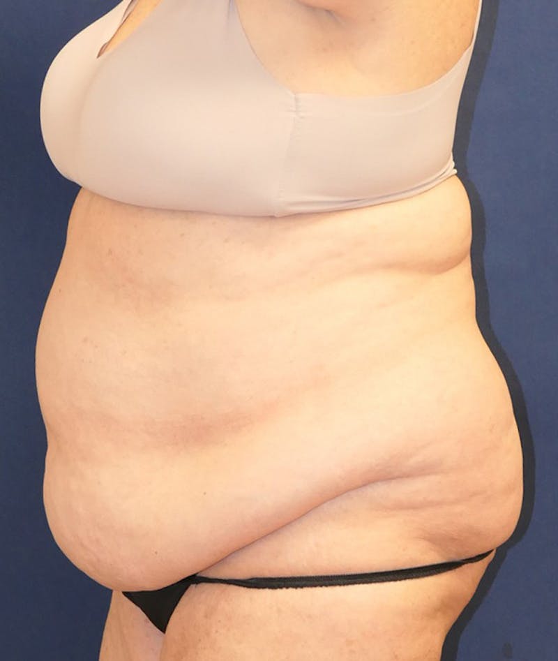 Tummy Tuck (Abdominoplasty) Before & After Gallery - Patient 241760 - Image 7