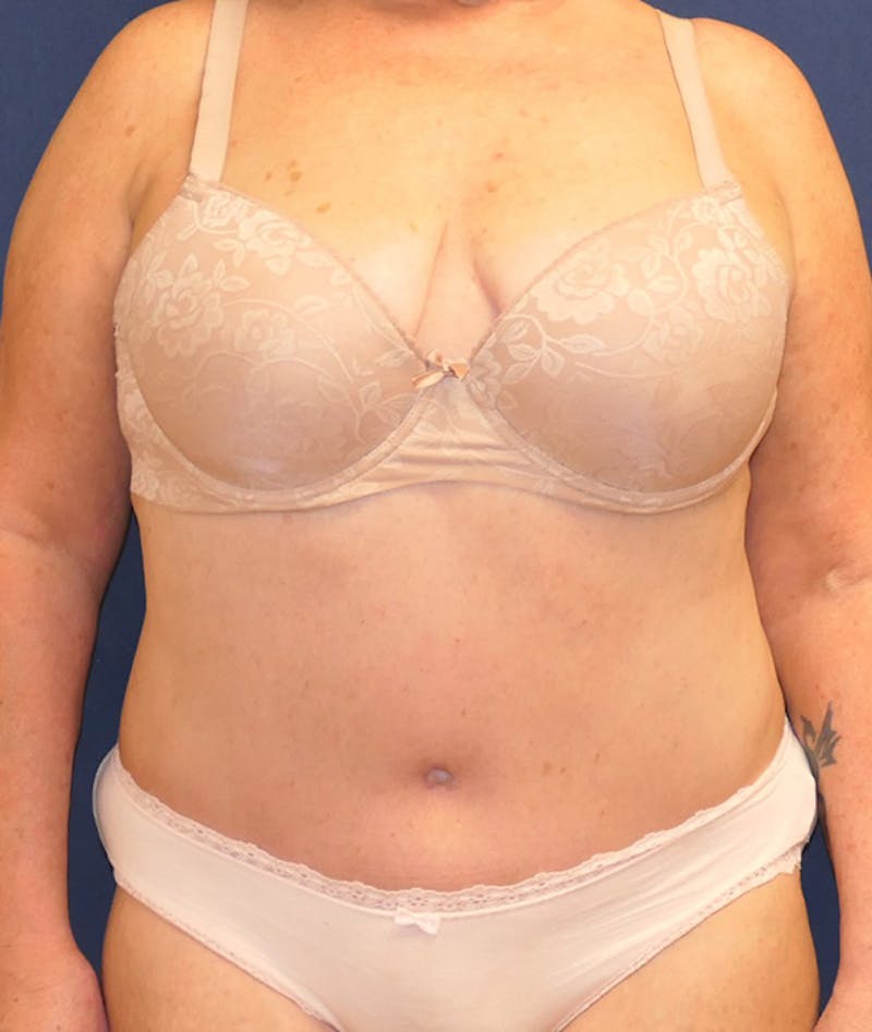 Tummy Tuck (Abdominoplasty) Before & After Gallery - Patient 241760 - Image 2