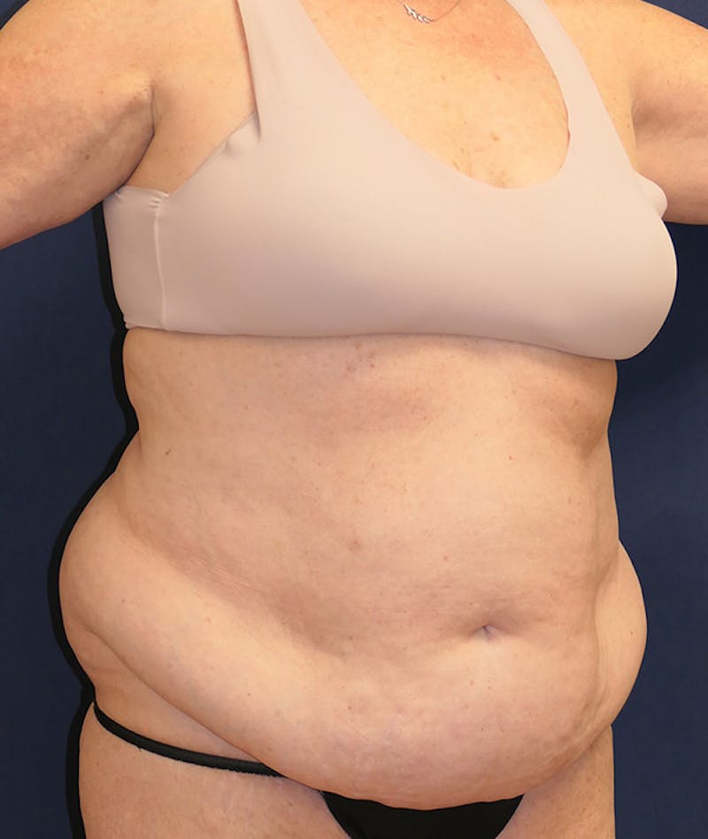 Tummy Tuck (Abdominoplasty) Before & After Gallery - Patient 241760 - Image 3