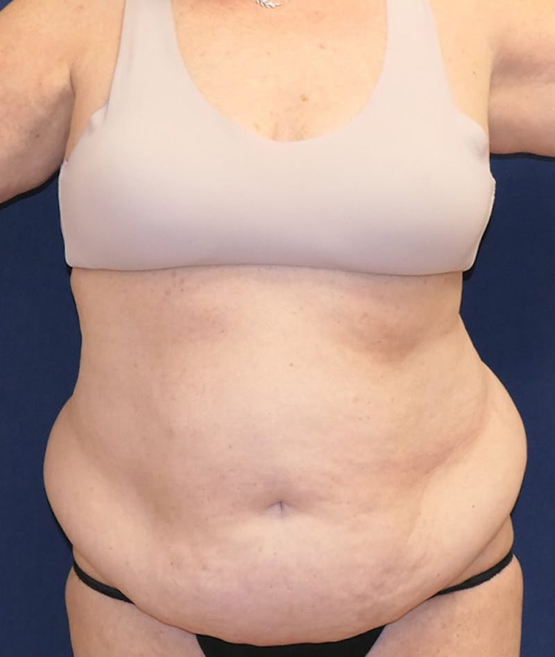 Tummy Tuck (Abdominoplasty) Before & After Gallery - Patient 241760 - Image 1