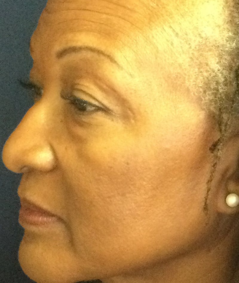 Eyelid Lift (Blepharoplasty) Before & After Gallery - Patient 226862 - Image 5