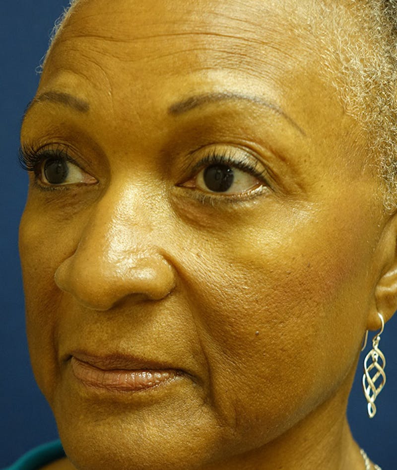 Eyelid Lift (Blepharoplasty) Before & After Gallery - Patient 226862 - Image 6