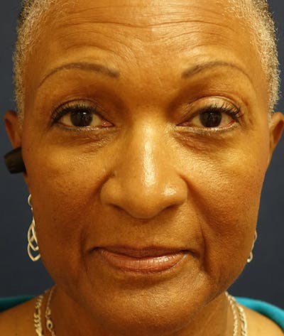 Eyelid Lift (Blepharoplasty) Before & After Gallery - Patient 226862 - Image 2