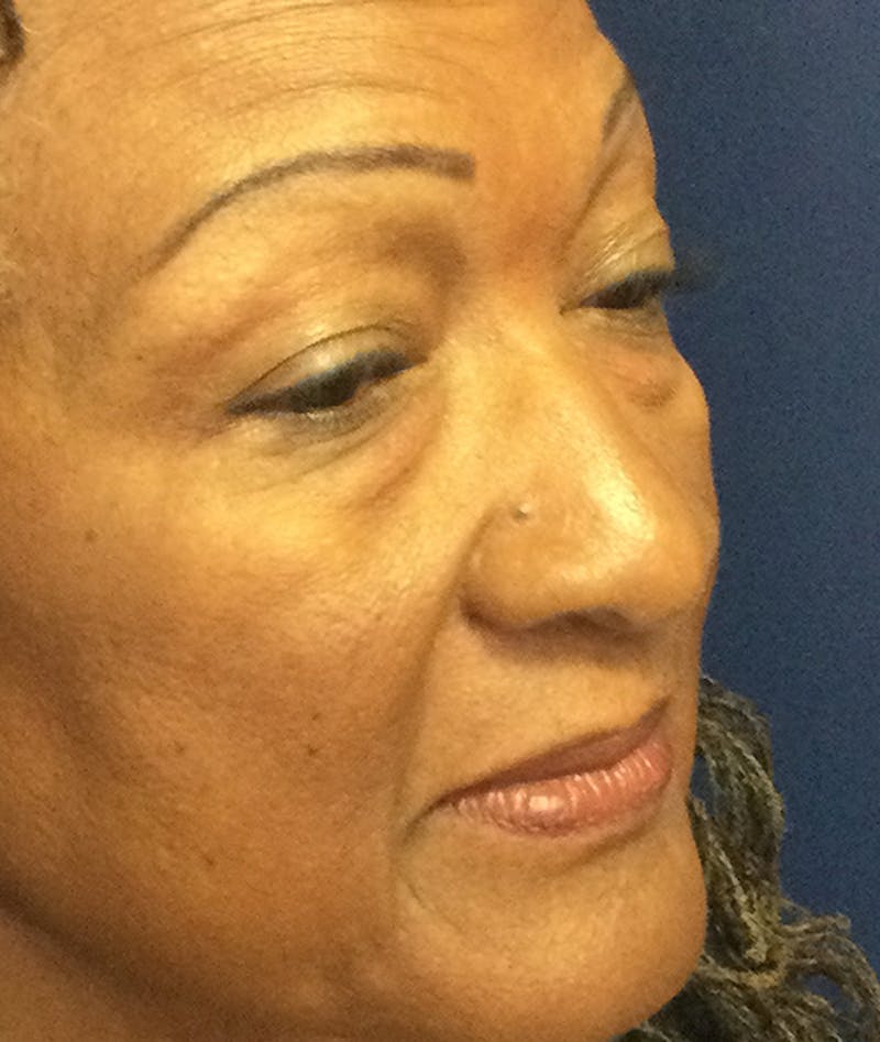 Eyelid Lift (Blepharoplasty) Before & After Gallery - Patient 226862 - Image 3
