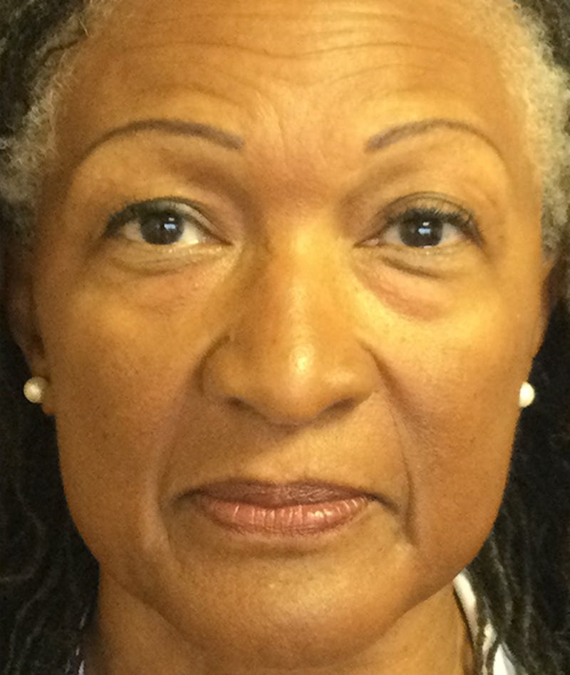 Eyelid Lift (Blepharoplasty) Before & After Gallery - Patient 226862 - Image 1