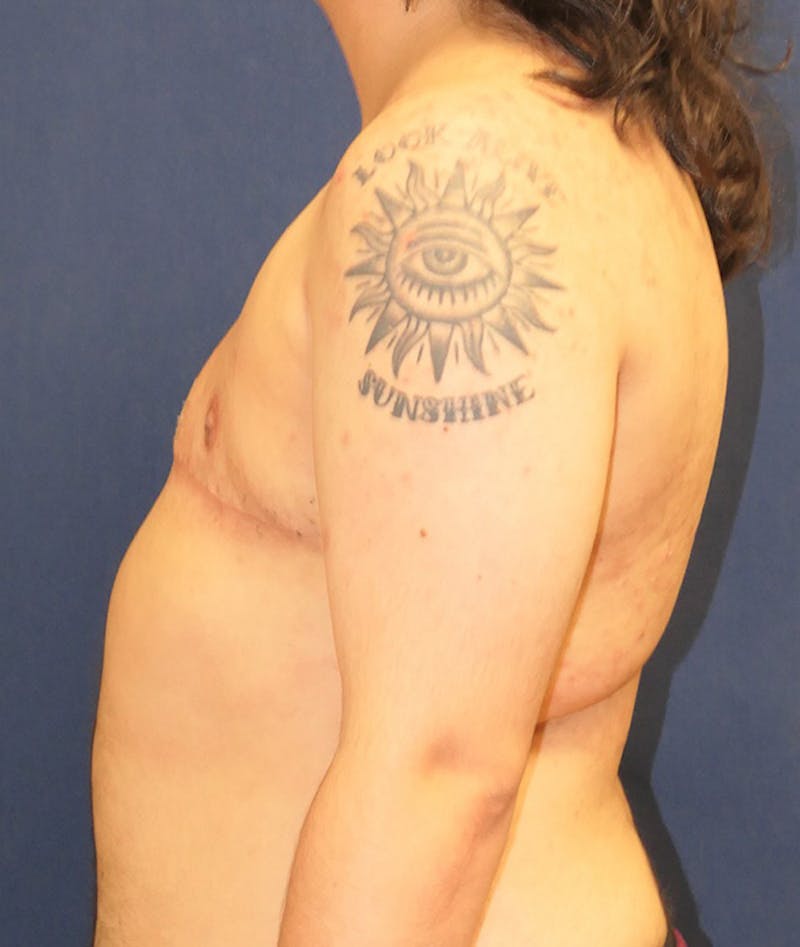 Masculinizing Surgery Before & After Gallery - Patient 231034 - Image 4