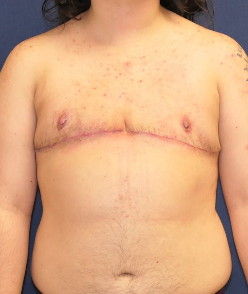 Masculinizing Surgery Before & After Gallery - Patient 231034 - Image 2