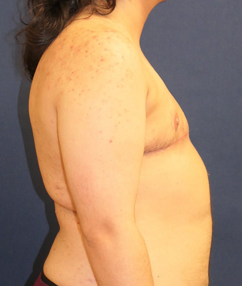 Masculinizing Surgery Before & After Gallery - Patient 231034 - Image 6