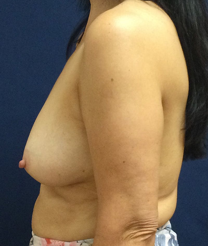 Breast Augmentation Before & After Gallery - Patient 137881 - Image 5