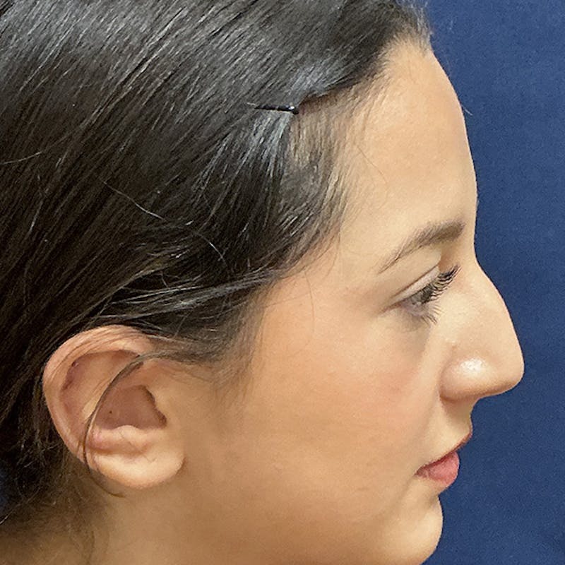 Ear Pinning (Otoplasty) Before & After Gallery - Patient 187588 - Image 4