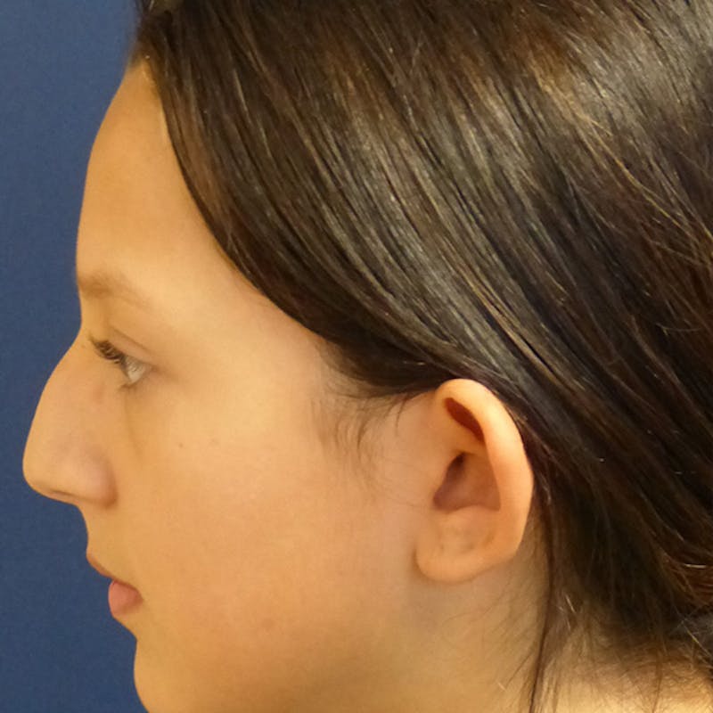 Ear Pinning (Otoplasty) Before & After Gallery - Patient 187588 - Image 5