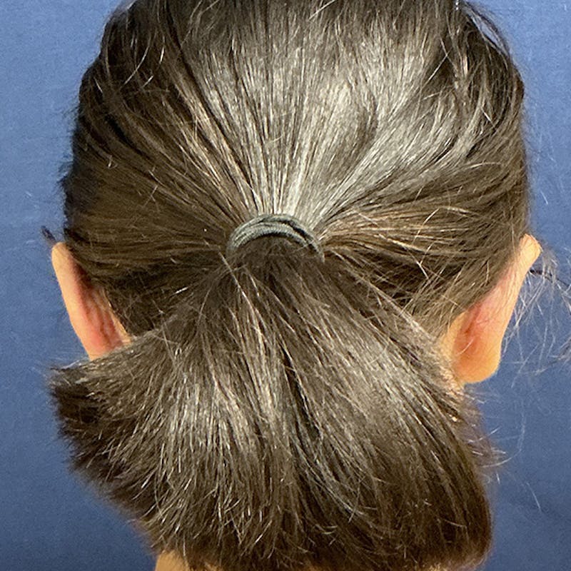 Ear Pinning (Otoplasty) Before & After Gallery - Patient 187588 - Image 8