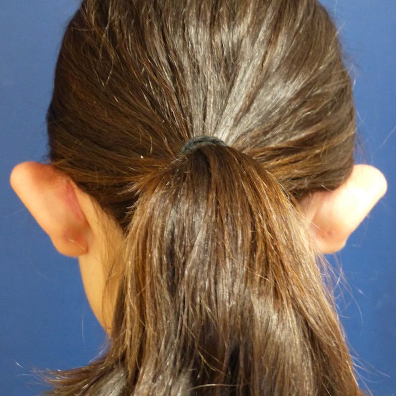 Ear Pinning (Otoplasty) Before & After Gallery - Patient 187588 - Image 7