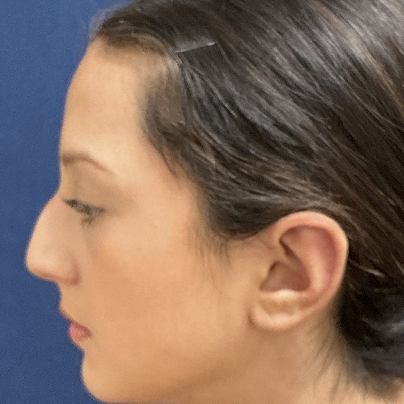 Ear Pinning (Otoplasty) Before & After Gallery - Patient 187588 - Image 6