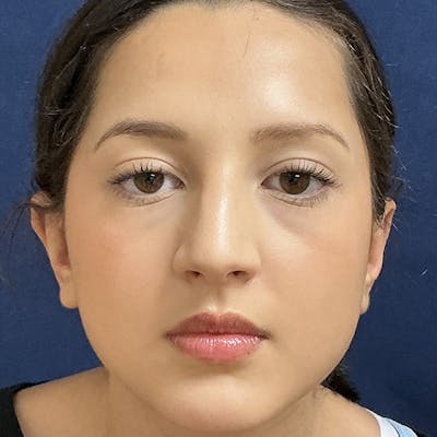 Ear Pinning (Otoplasty) Before & After Gallery - Patient 187588 - Image 2