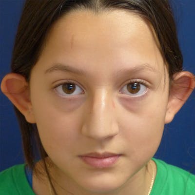 Ear Pinning (Otoplasty) Before & After Gallery - Patient 187588 - Image 1
