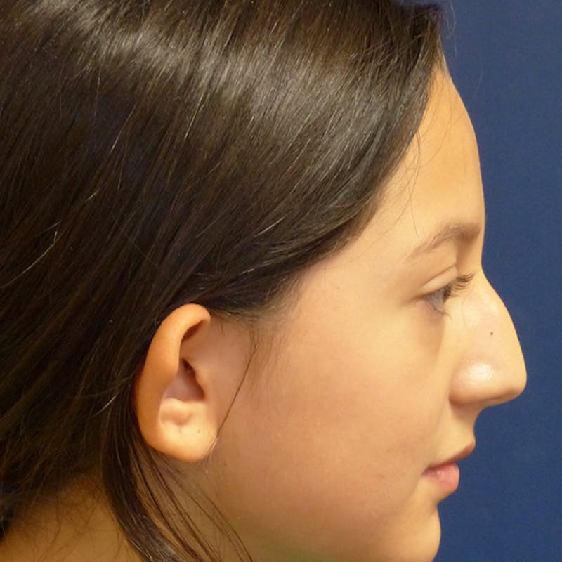 Ear Pinning (Otoplasty) Before & After Gallery - Patient 187588 - Image 3
