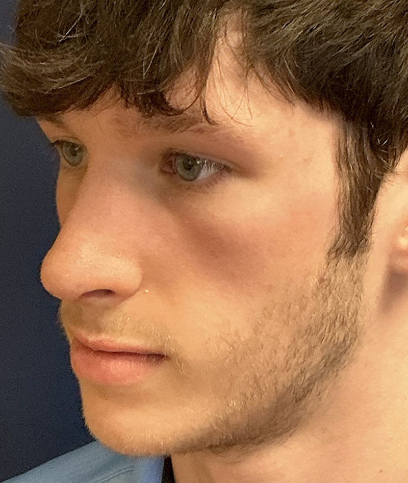Rhinoplasty Before & After Gallery - Patient 267759 - Image 8