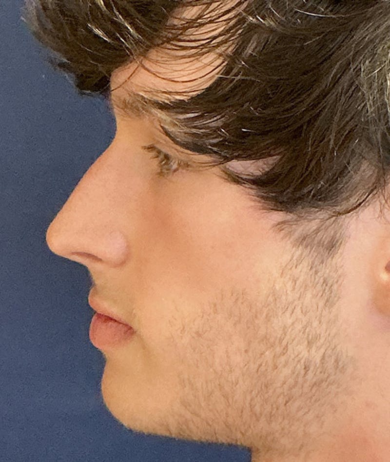 Rhinoplasty Before & After Gallery - Patient 267759 - Image 9