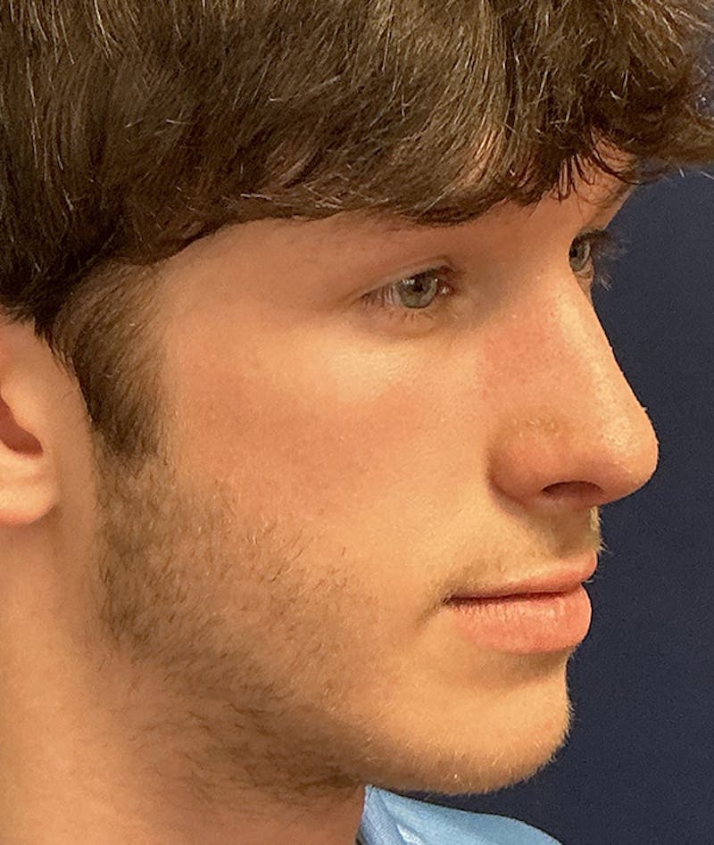 Rhinoplasty Before & After Gallery - Patient 267759 - Image 4