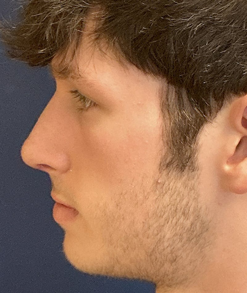 Rhinoplasty Before & After Gallery - Patient 267759 - Image 10