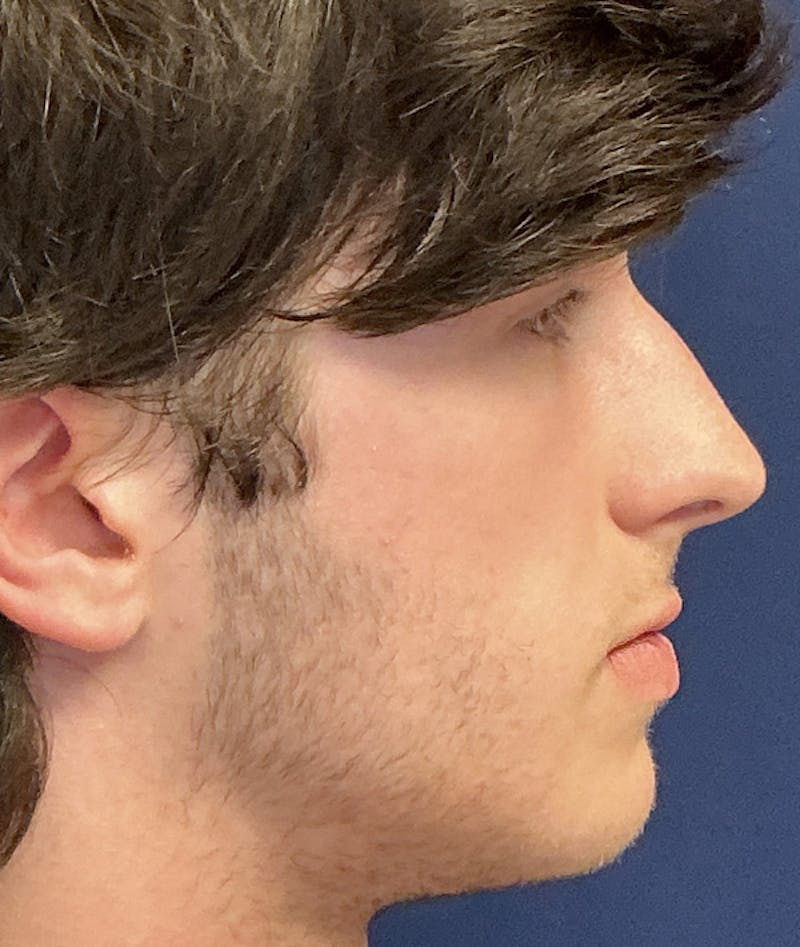 Rhinoplasty Before & After Gallery - Patient 267759 - Image 5