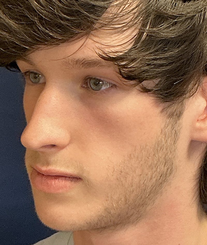 Rhinoplasty Before & After Gallery - Patient 267759 - Image 7