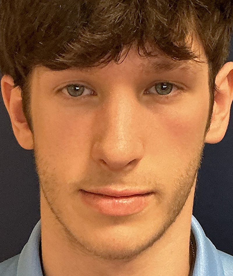 Rhinoplasty Before & After Gallery - Patient 267759 - Image 2