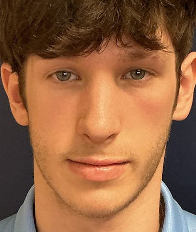 Rhinoplasty Before & After Gallery - Patient 267759 - Image 2
