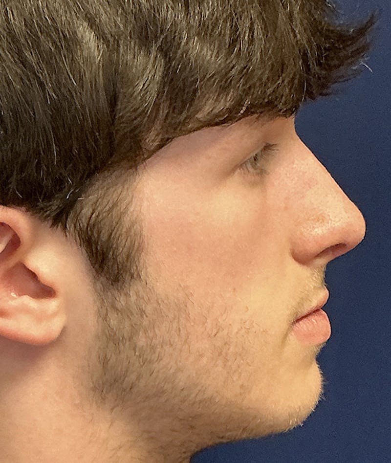 Rhinoplasty Before & After Gallery - Patient 267759 - Image 6