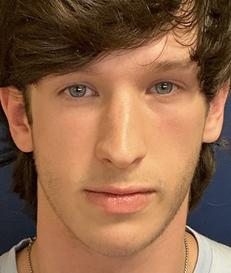 Rhinoplasty Before & After Gallery - Patient 267759 - Image 1