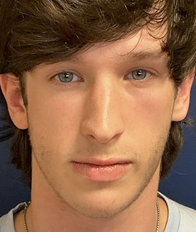 Rhinoplasty Before & After Gallery - Patient 267759 - Image 1