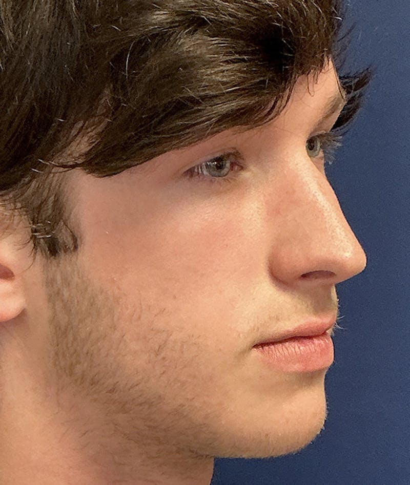 Rhinoplasty Before & After Gallery - Patient 267759 - Image 3