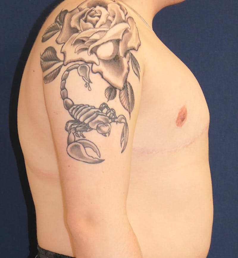 Masculinizing Surgery Before & After Gallery - Patient 315784 - Image 4