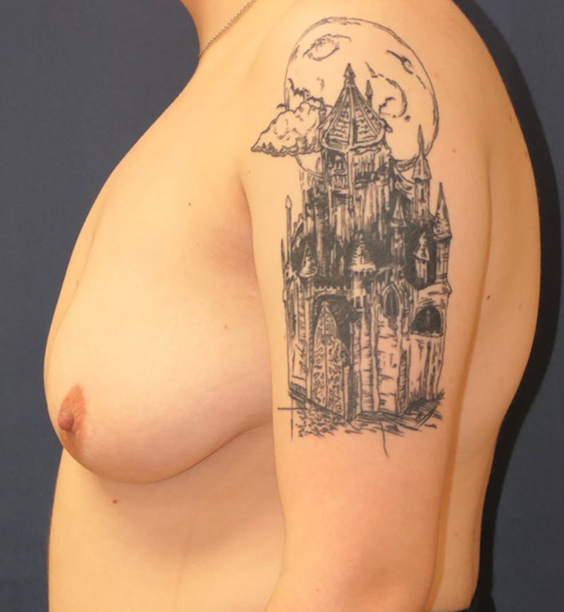 Masculinizing Surgery Before & After Gallery - Patient 315784 - Image 5