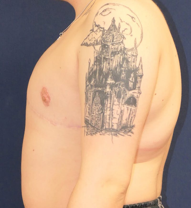 Masculinizing Surgery Before & After Gallery - Patient 315784 - Image 6