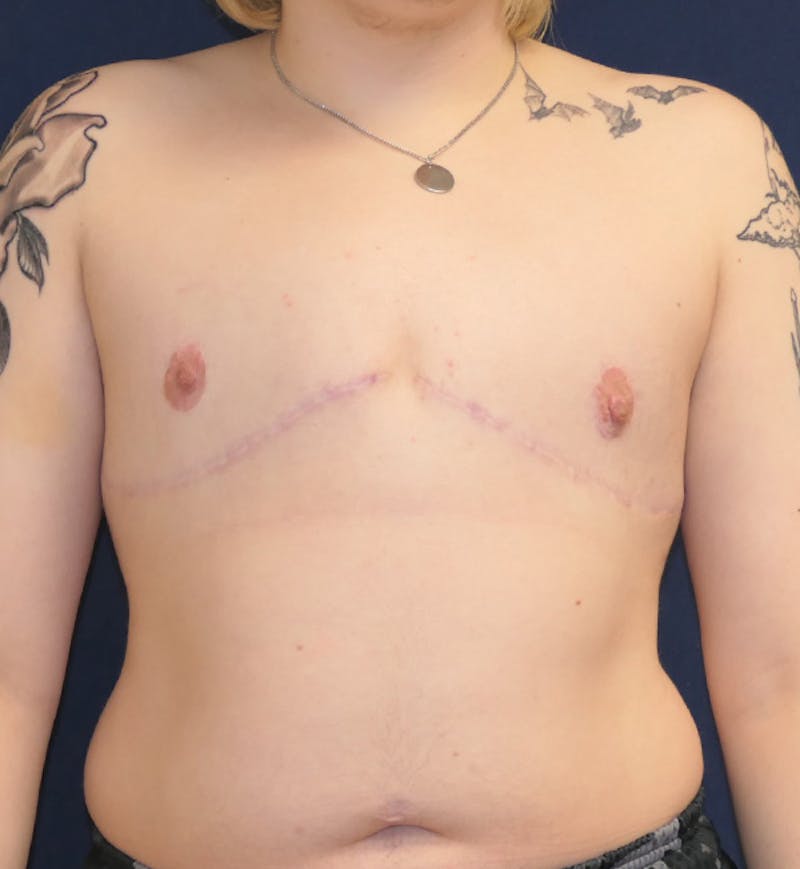 Masculinizing Surgery Before & After Gallery - Patient 315784 - Image 2