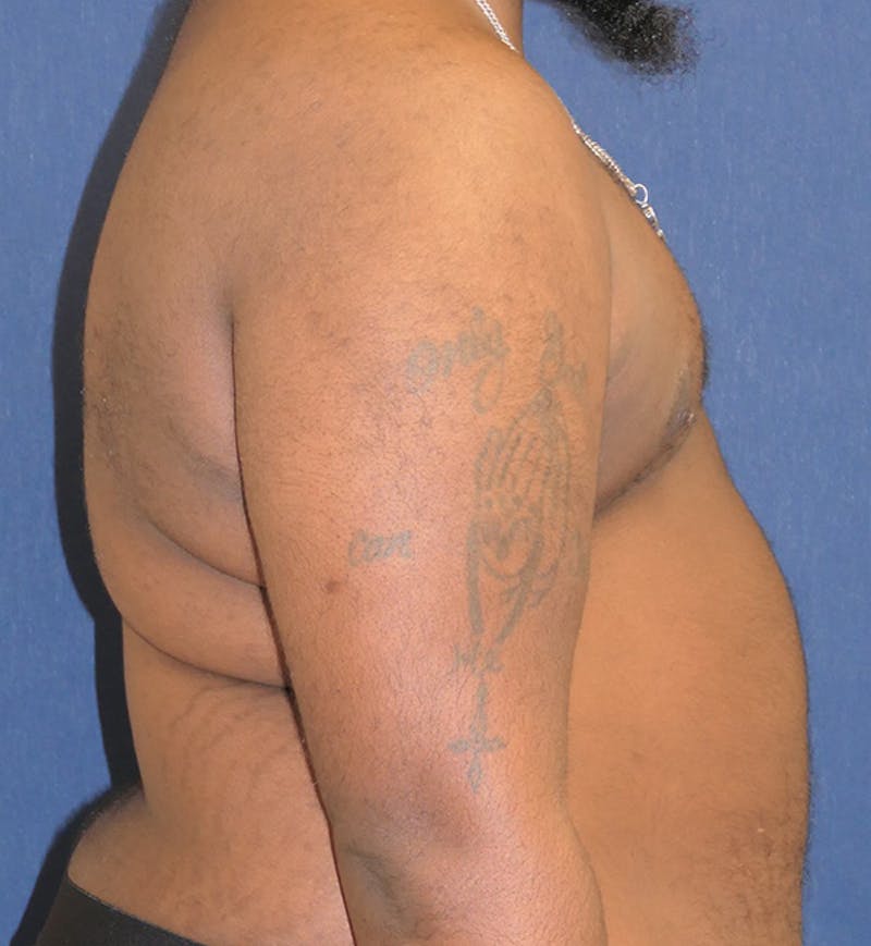 Masculinizing Surgery Before & After Gallery - Patient 398893 - Image 4