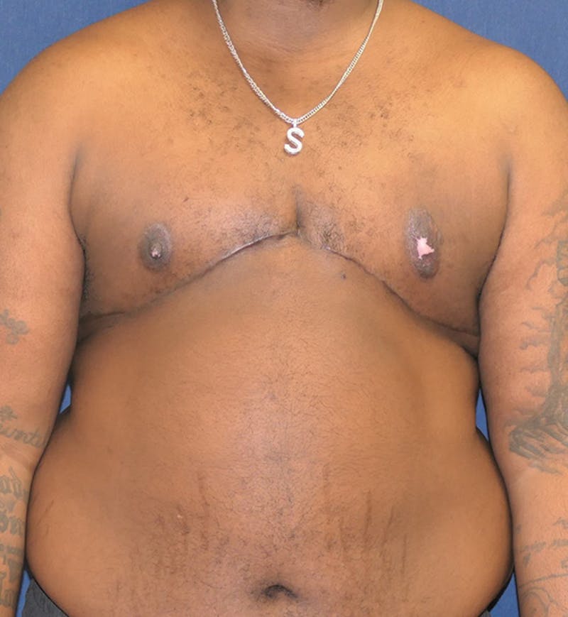 Masculinizing Surgery Before & After Gallery - Patient 398893 - Image 2