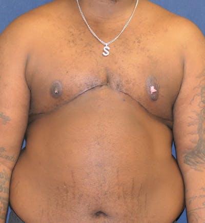 Masculinizing Surgery Before & After Gallery - Patient 398893 - Image 2