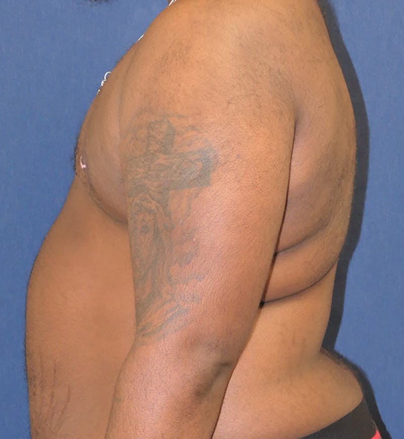 Masculinizing Surgery Before & After Gallery - Patient 398893 - Image 6