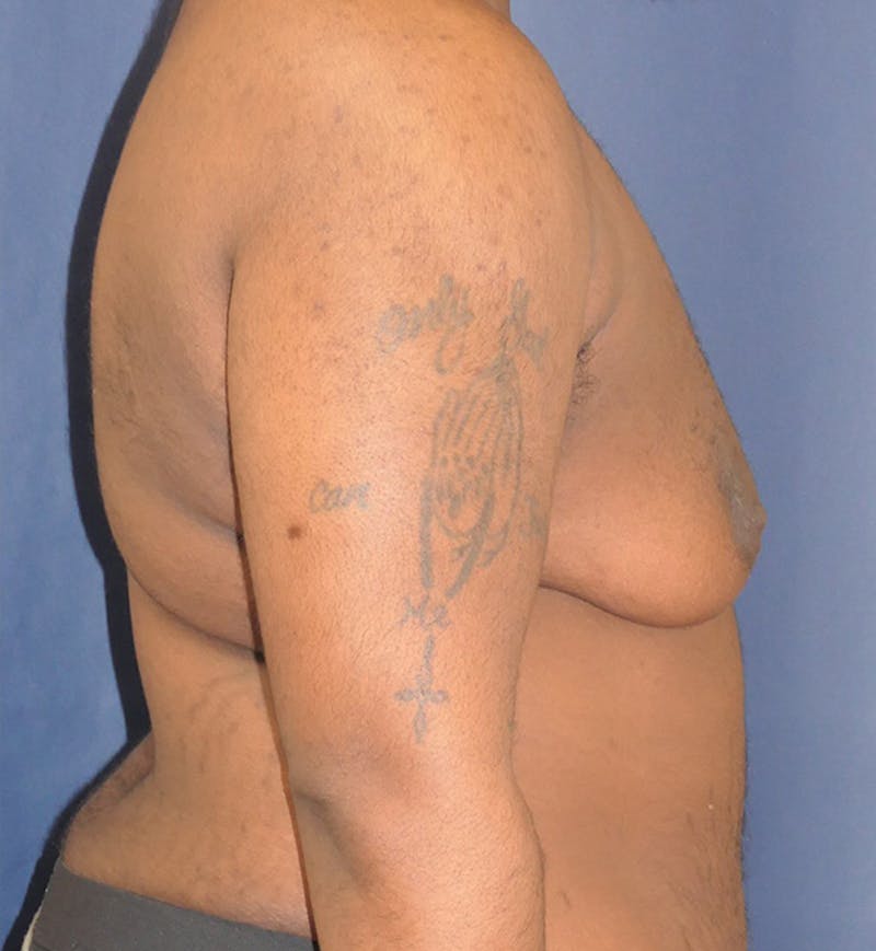 Masculinizing Surgery Before & After Gallery - Patient 398893 - Image 3
