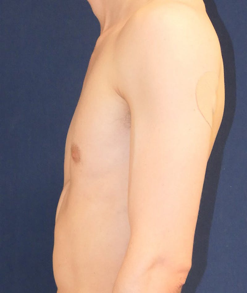 Pectoral Implants Before & After Gallery - Patient 274796 - Image 5
