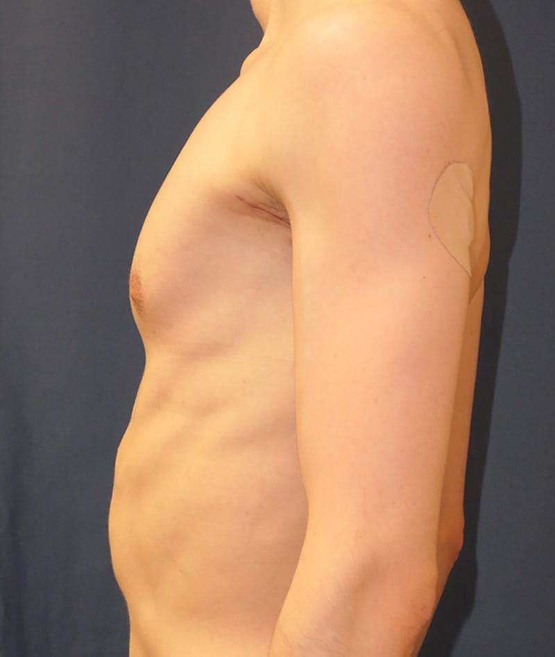 Pectoral Implants Before & After Gallery - Patient 274796 - Image 6